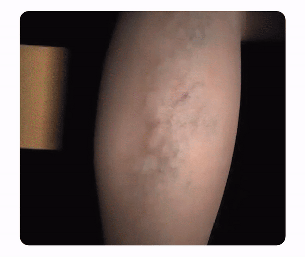 Parches Mágicos para Varices